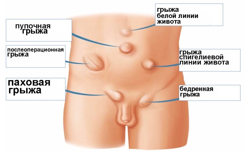 Расположение грыж брюшной стенки.