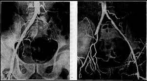 КТ-ангиография подвздошной артерии - что показывают снимки