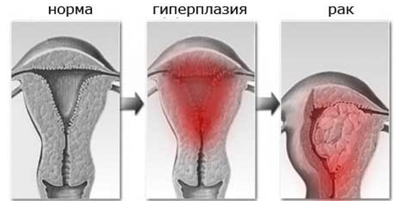 Стадии развития гиперплазии.