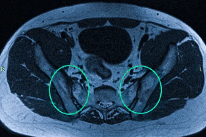 Сакроилеит КПС на МРТ.