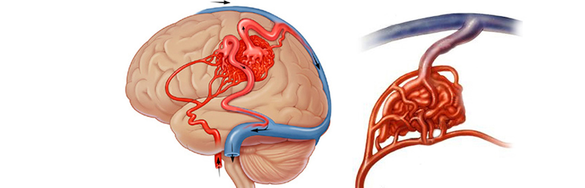 Мальформации сосудов головного мозга