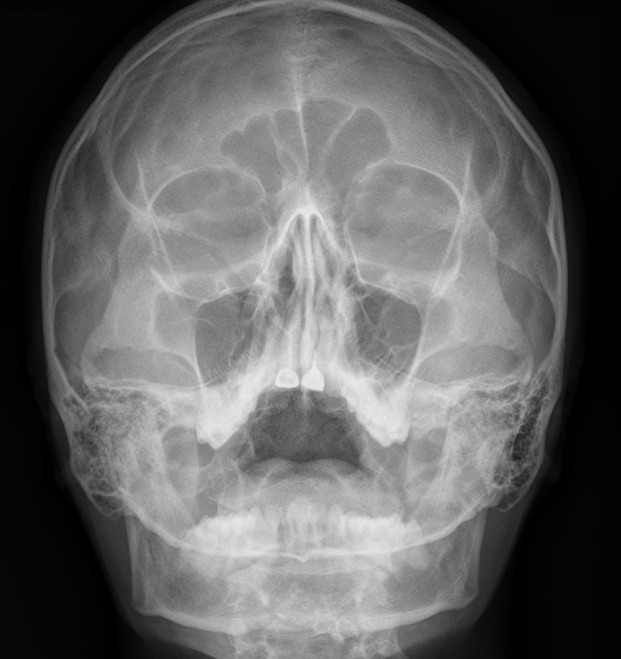 Рентген пазух носа - что показывают снимки