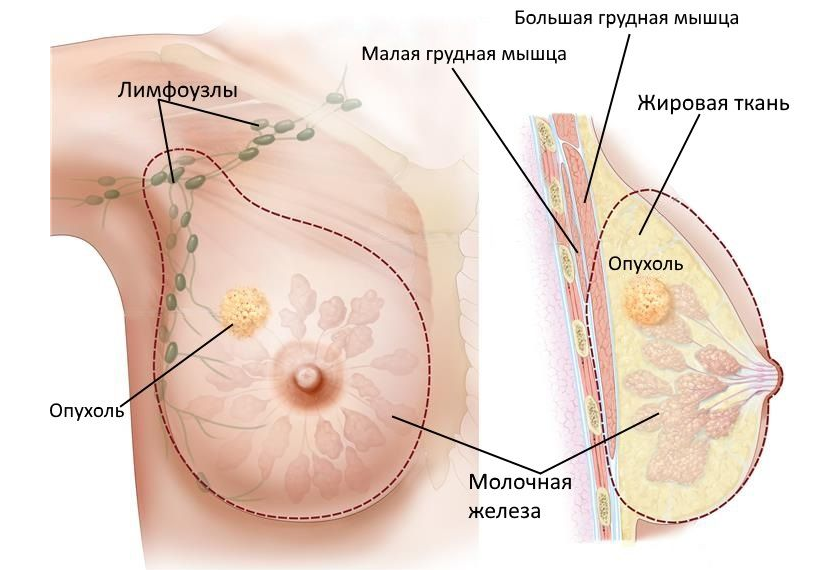 Строение молочной железы и расположение опухолей.