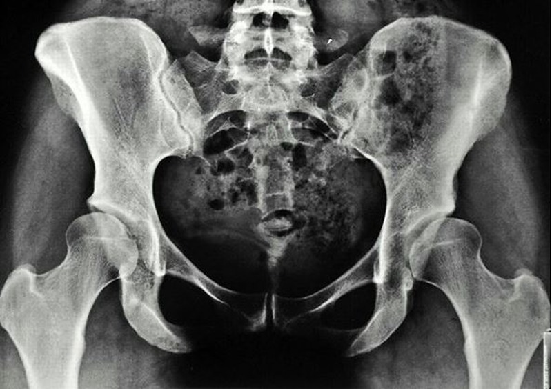Рентген тазобедренного сустава - снимки