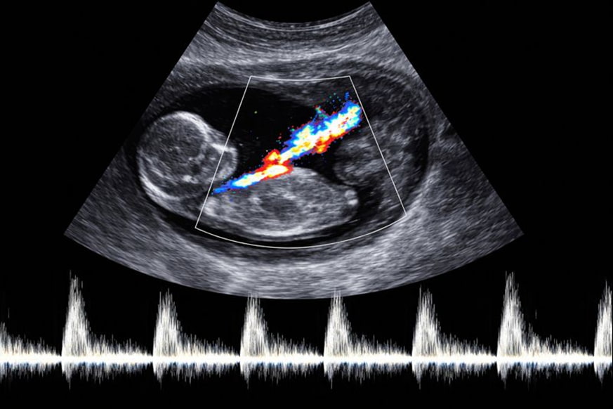 УЗДГ маточно-плацентарного кровотока - снимки.