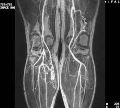МРТ сосудов нижних конечностей - снимки