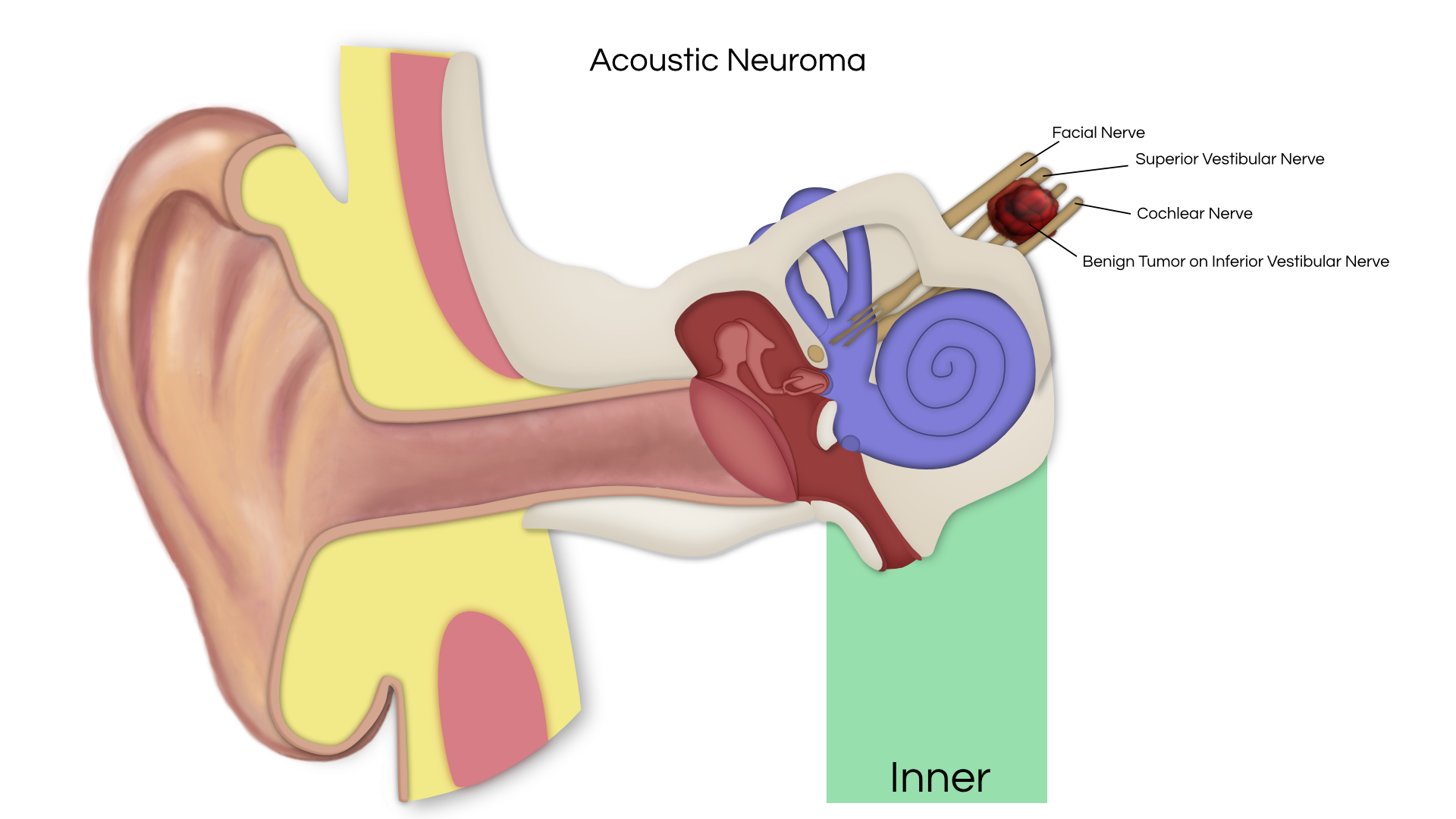 Невринома слухового нерва