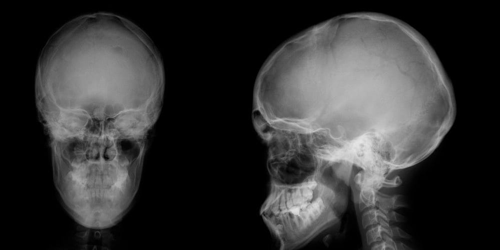 Рентген черепа