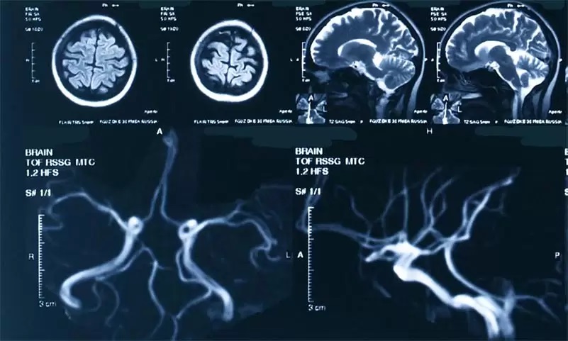 МРТ сосудов головного мозга - МРА (снимки)