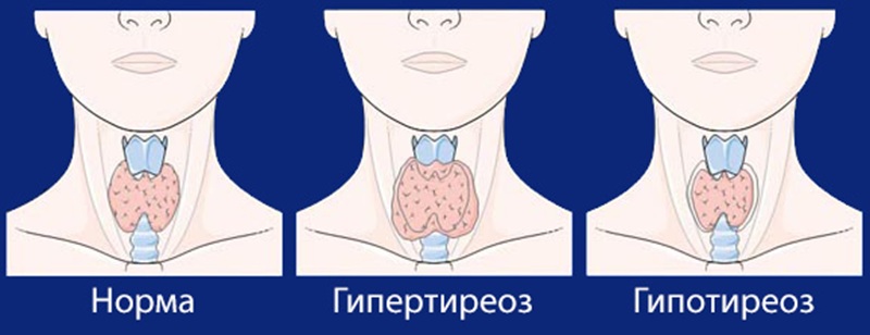 Щитовидная железа в норме, при гипо- и гипертиреозе.