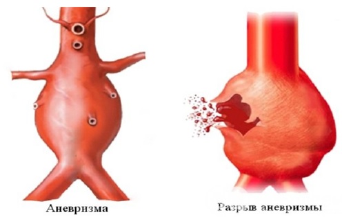 КТ грудной аорты и легочной артерии - показания