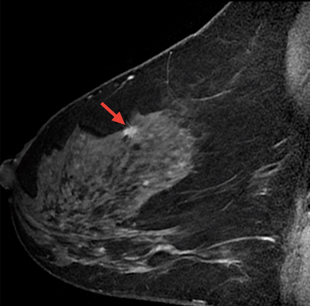 Рак молочной железы на снимках МРТ