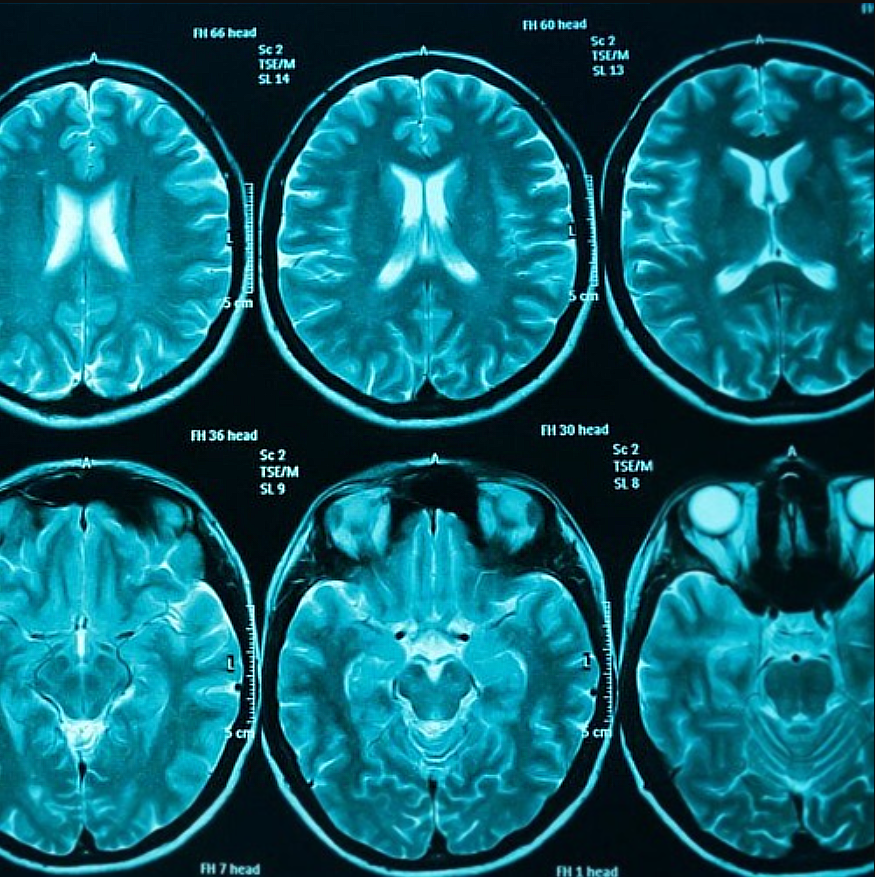 Снимки МРТ головного мозга