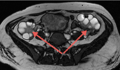 МРТ яичников - снимки