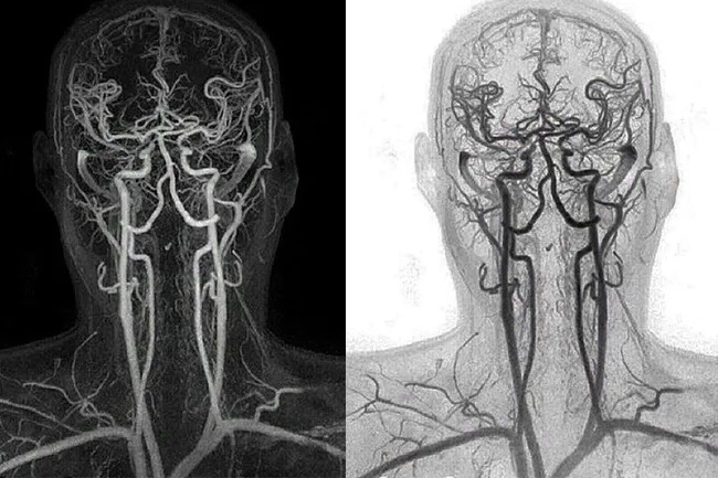 КТ-ангиография головного мозга - что показывают снимки
