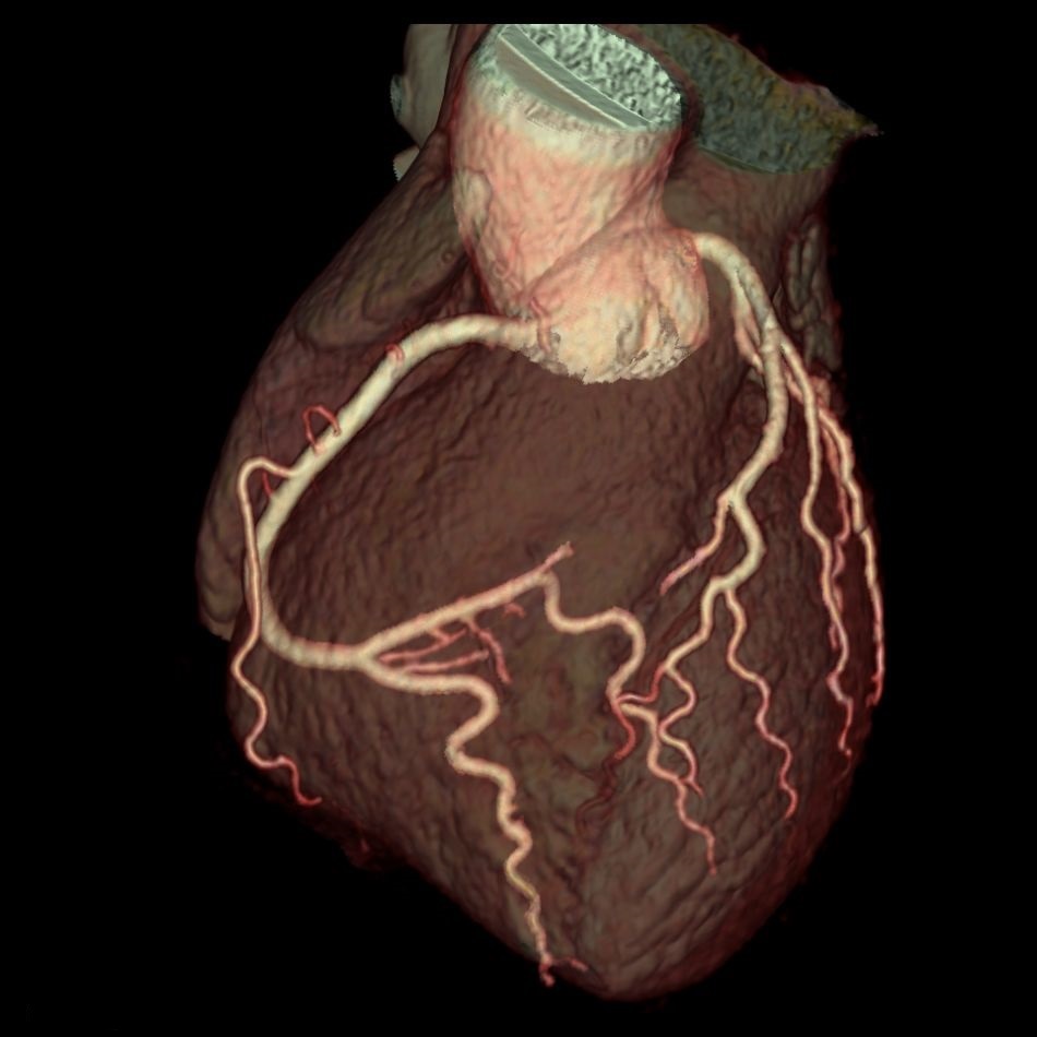 КТ-коронарография - диагностика сосудов сердца
