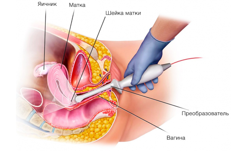 Проведение трансвагинального УЗИ малого таза - схема.