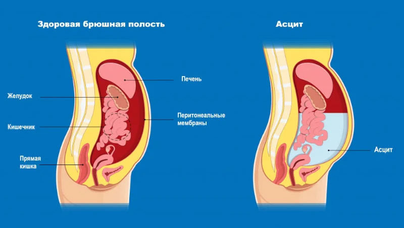 Асцит брюшной полости.