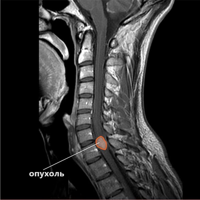 Опухоль спинного мозга на снимке МРТ шейного отдела позвоночника