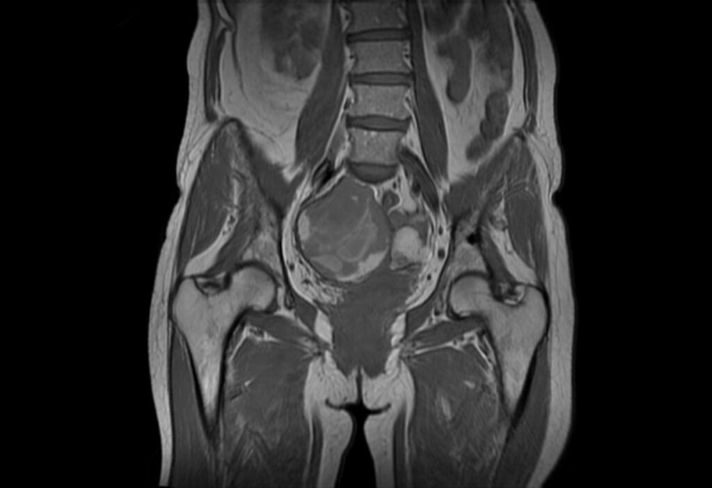 МРТ снимок органов малого таза у женщины