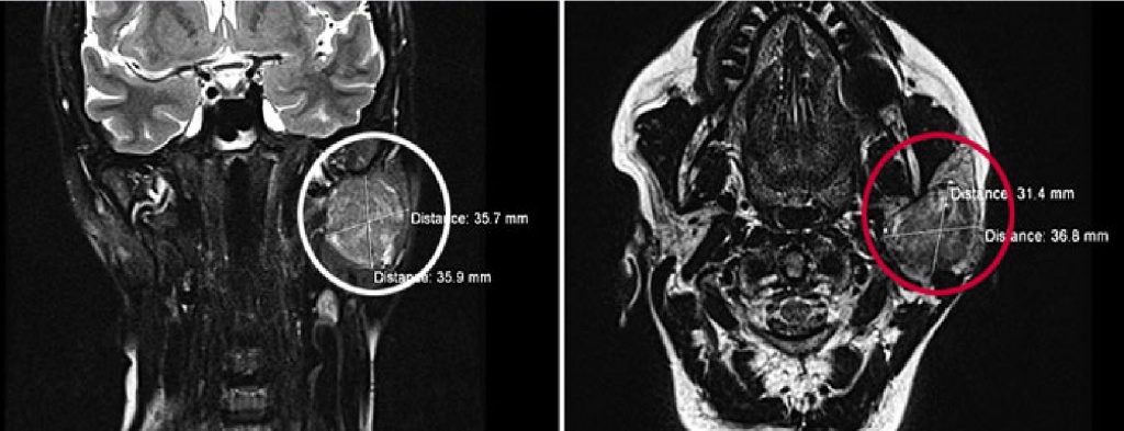 Снимок МРТ слюнных желез