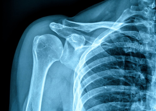 Рентген плечевого сустава - что показывают снимки