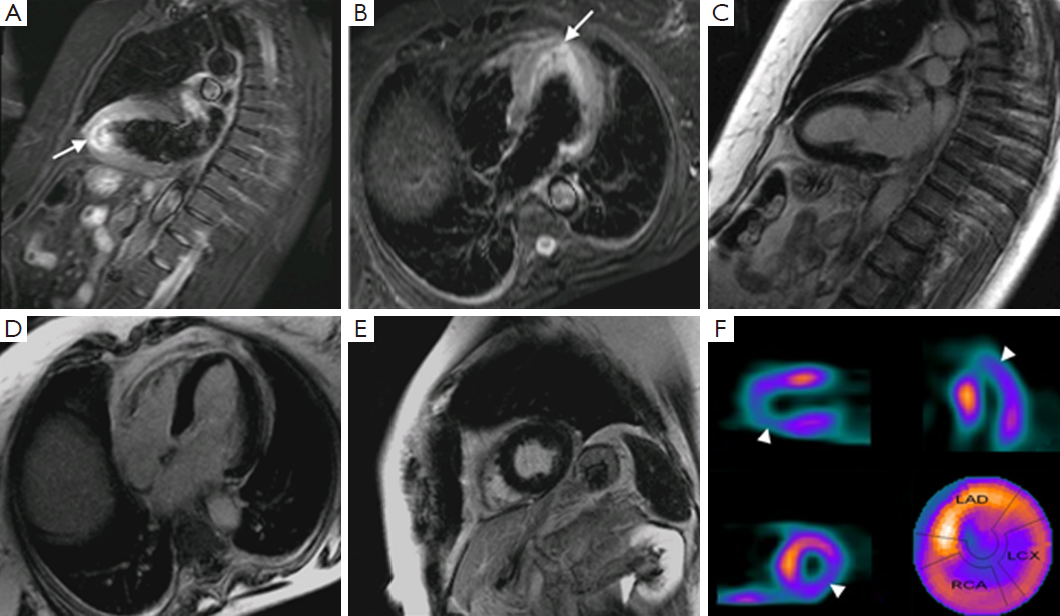 Снимки МРТ сердца с гадолинием