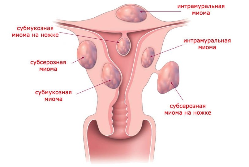 Виды и расположение миомы матки.