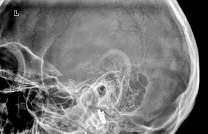 Рентген височных костей по Шюллеру - снимки