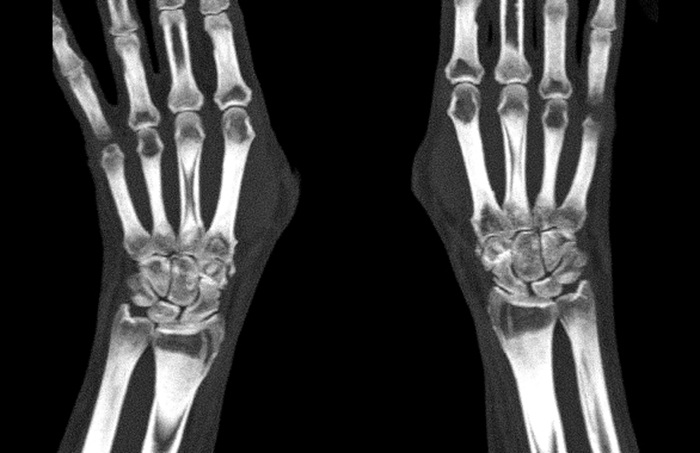 КТ лучезапястного сустава - диагностика
