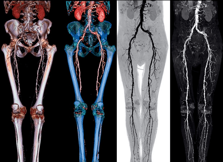 КТ сосудов малого таза и нижних конечностей - КТА (снимки)