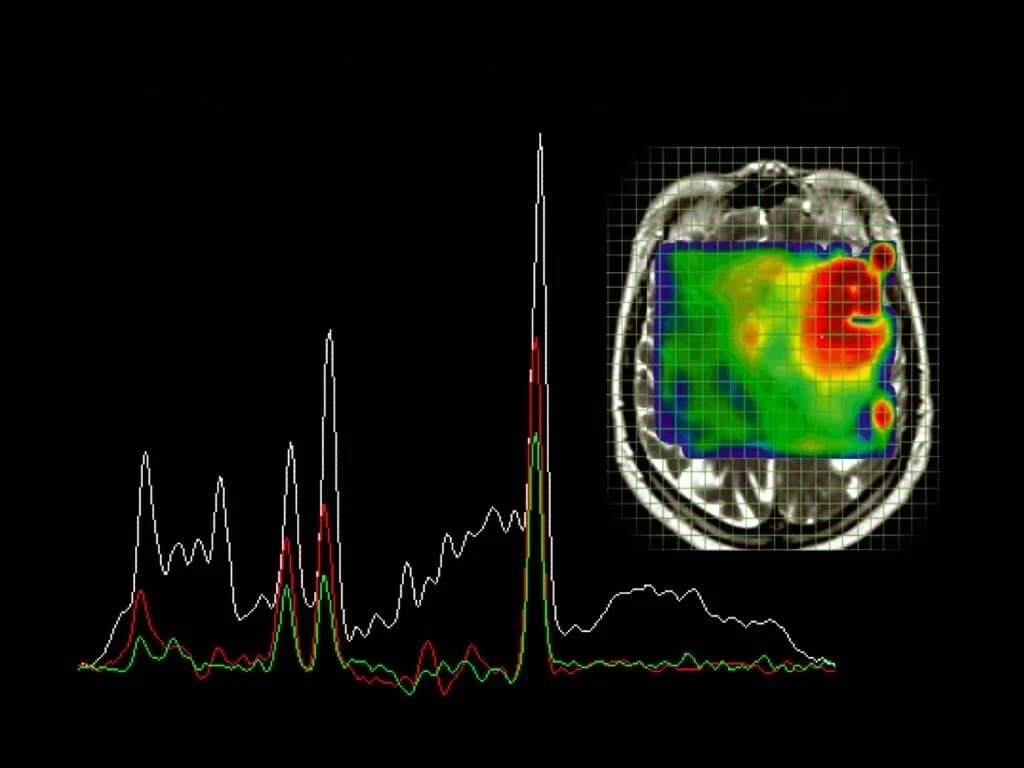 МР-спектроскопия головного мозга
