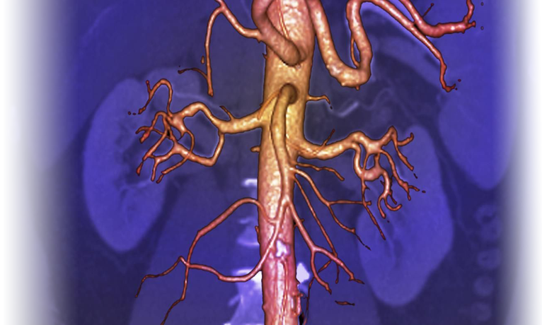 КТ-ангиография почечных артерий - описание диагностики