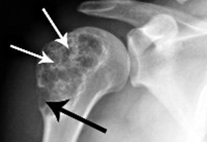 Рентген плечевой кости при остеосаркоме - снимки