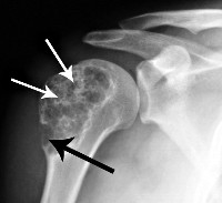 Рентген плечевой кости при остеосаркоме - снимки
