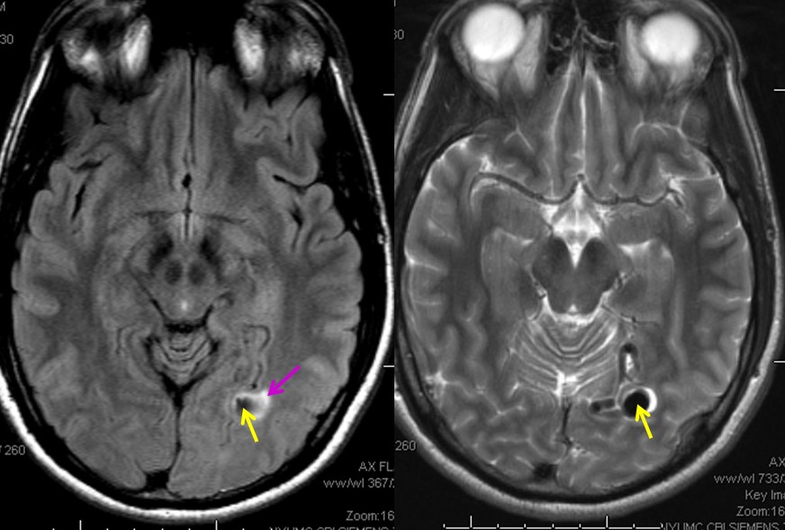 Аневризма головного мозга на МРТ