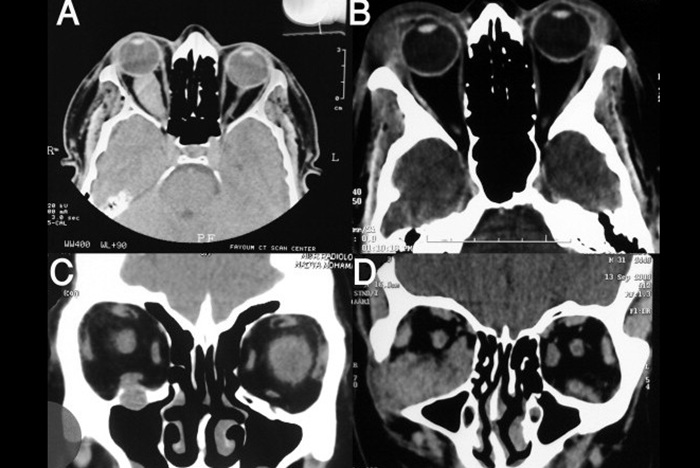 КТ глазных орбит - диагностика