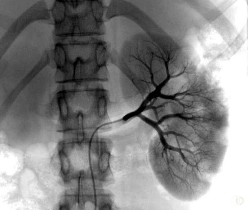 Рентген-экскреторная урография - диагностика