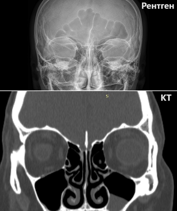 Сравнение снимков КТ пазух носа и рентгена
