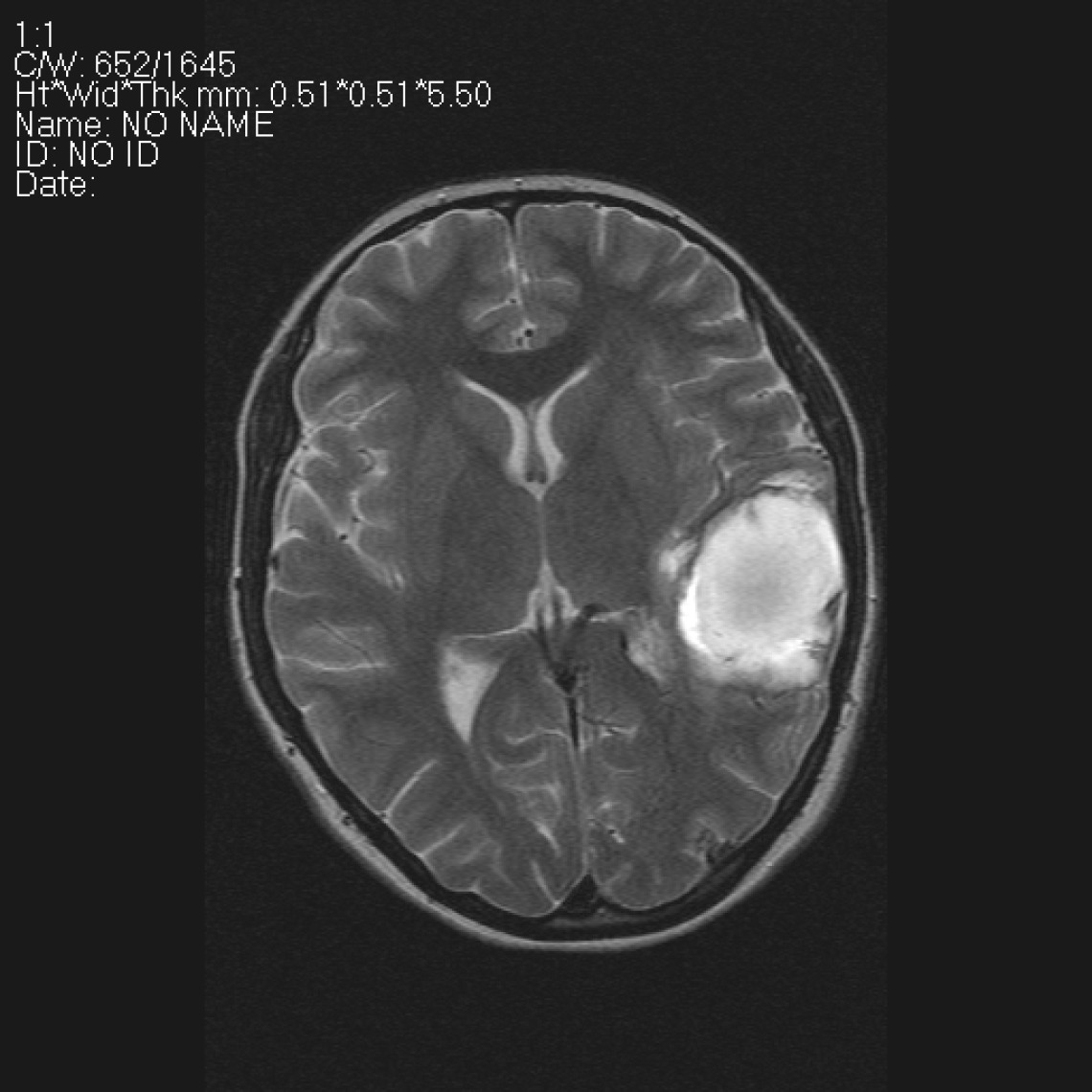 Инсульт мозга на МРТ