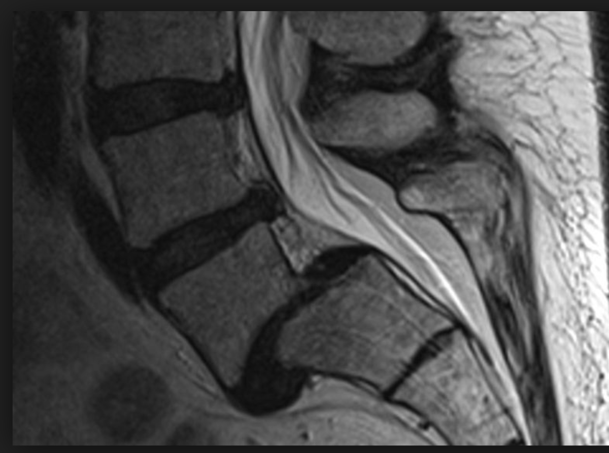 Смещение позвонка (спондилолистез) на МРТ позвоночника