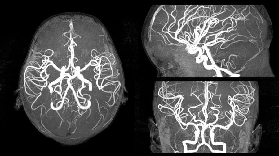 МРТ сосудов головного мозга - снимки в разных ракурсах