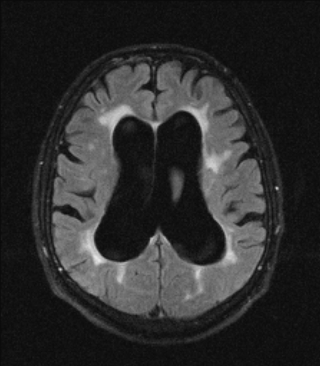 Гидроцефалия на МРТ головного мозга
