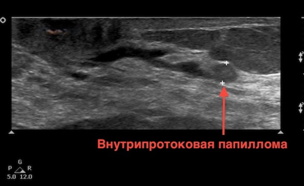 Внутрипротоковая папиллома на УЗИ молочной железы.