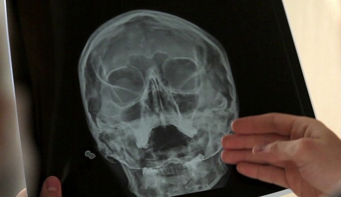 Рентген височных костей по Шюллеру - результаты