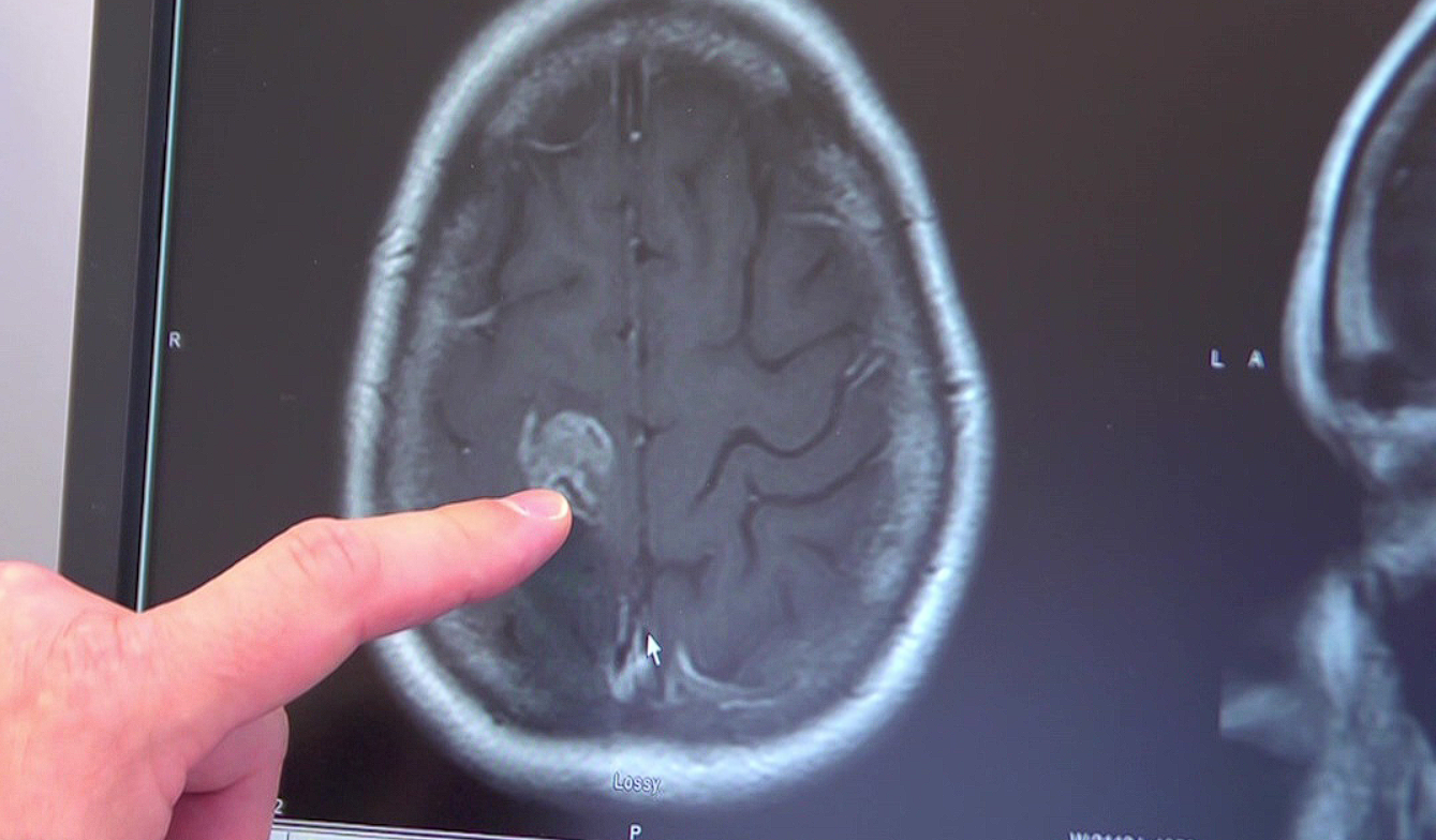 Глиома головного мозга на МРТ