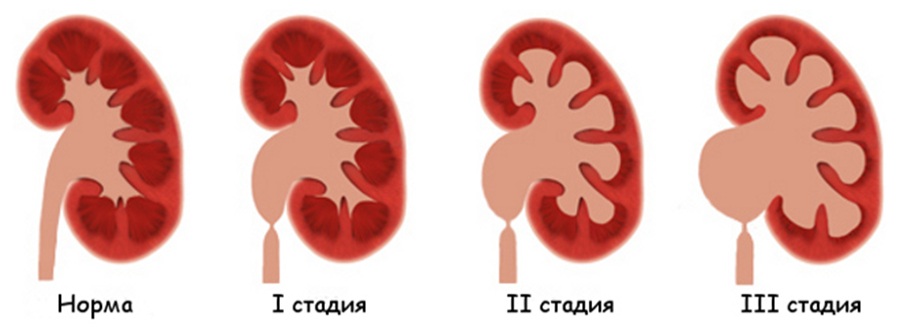 Стадии каликоэктазии почки, схема.