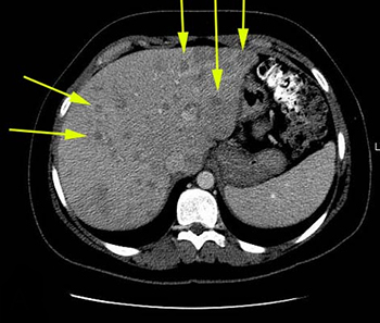 КТ печени - снимки