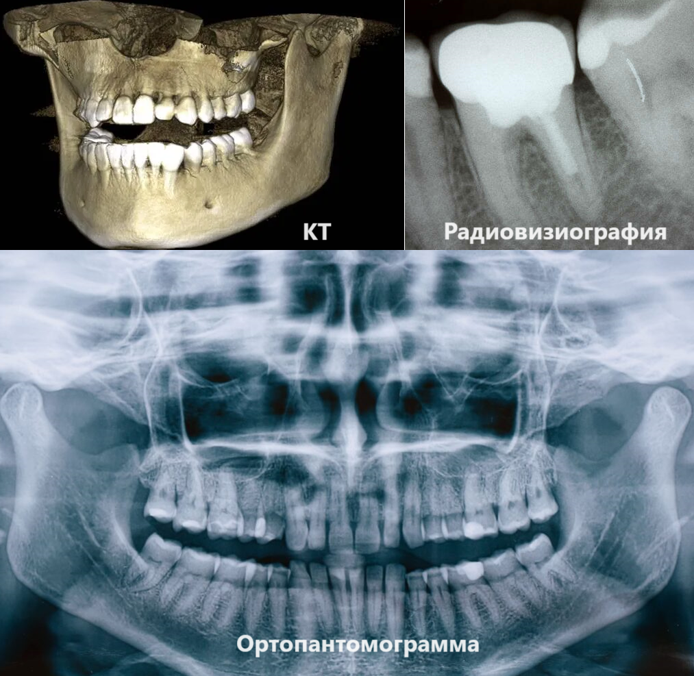 Сравнение снимков КТ челюсти, рентгена зуба и панорамного снимка