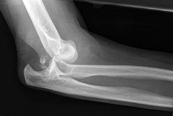 Рентген локтевого сустава - что показывают снимки